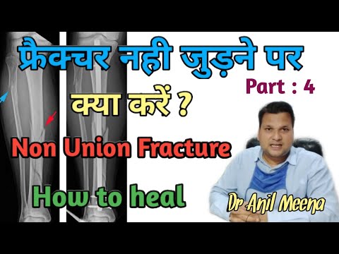 Non Union Fracture  Treatment | How to Heal Non Union Fracture | Non Union Bone After Cast Treatment
