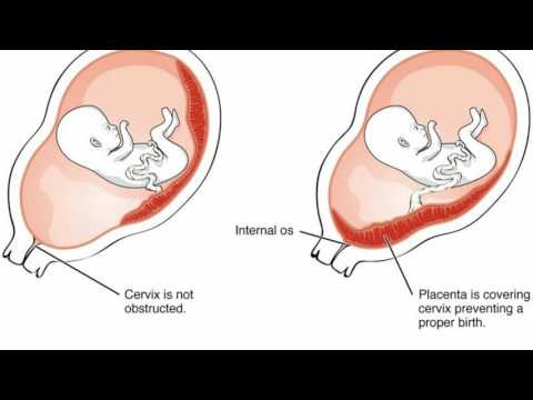 Video: Differenza Tra Amnion E Chorion