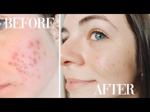 How I Cleared Up My Acne Tretinoin Doxycycline Accutane Big Sister Talks