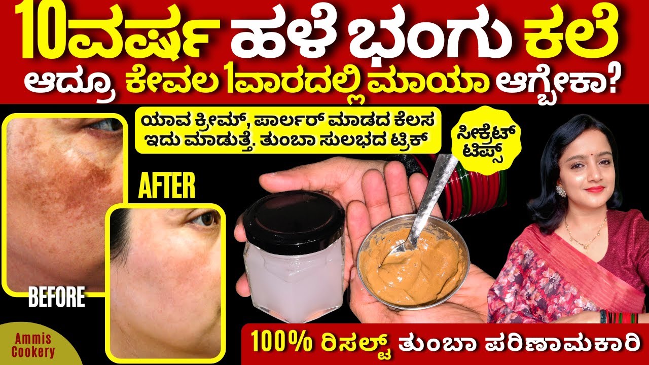 ಯಾವ ಕ್ರೀಮ್ ಬೇಡ, ದಿನಾ 10ನಿಮಿಷ ಹಚ್ಚಿ 10ವರ್ಷ ಹಳೆಯ ಭಂಗು ಕಲೆ ಮಾಯಾ The best home remedy for pigmentation