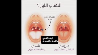 علاج التهاب الحلق مع الغرغره السحريه