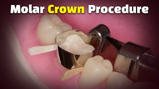 Step by Step Dental Crown Procedure (Glidewell Fastmill.io Posterior Back Molar Single Crown)