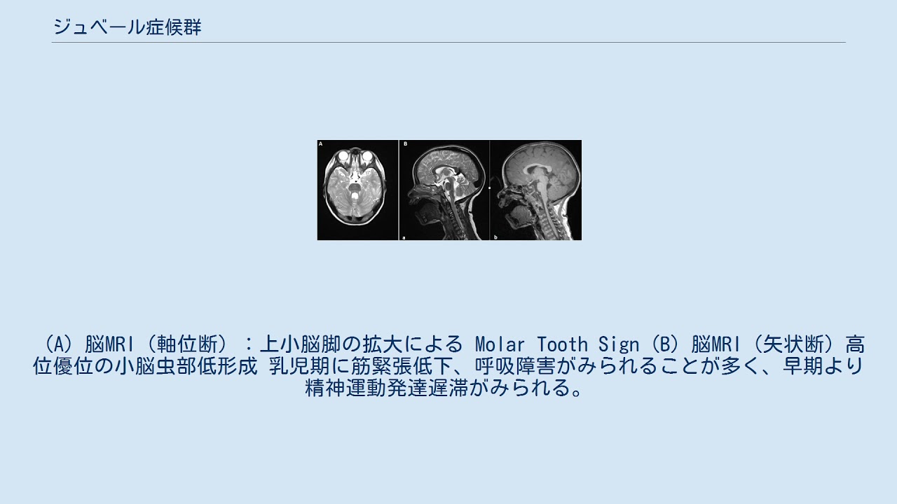 ジュベール症候群