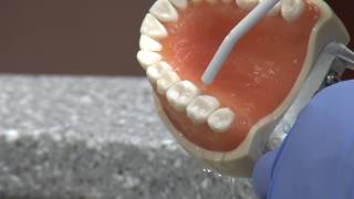 New cavity treatment offers no drilling, no filling