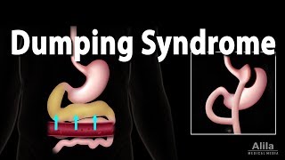 Dumping Syndrome, Animation screenshot 3