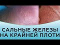 Сальные железы на крайней плоти