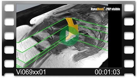 DynaMesh® MRI - Animation: MRI Reconstruction with DynaMesh®-PRP visible