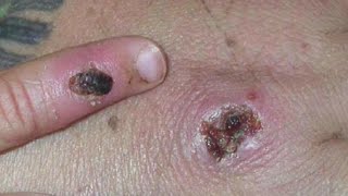 Monkeypox: Concern Grows More Case In Children Under The Age Of 8 May Be Seen In The Future