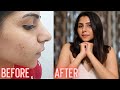How I Got Clear Skin! | Acne Skin Care Routine | Ishita Khanna