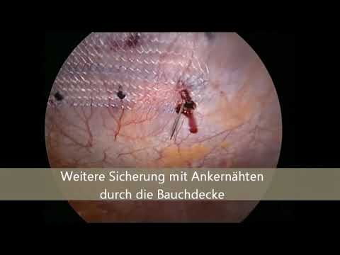 Hernien: Leistenbruch/ Nabelbruch/ Narbenbruch | Asklepios