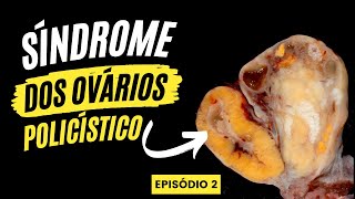 O Melhor Tratamento Para Ovário Policístico