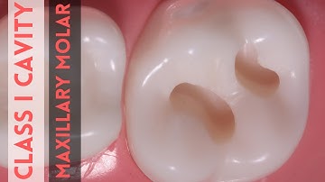 Class I Cavity Preparation 🟡 Amalgam Class I Cavity 🟢 Maxillary Molar 🔵