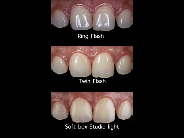 Dental Photography: Ring Flash or Twin Flash? Introducing the new Godox  MF12-DK1(s) and MF-R76. - YouTube