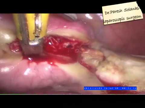 TOTAL LAPAROSCOPIC  HYSTERECTOMY