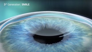 Comparing Laser Vision Correction Procedures (PRK, LASIK, SMILE) | LASIK in NYC