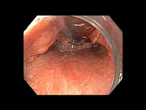 Video: Mida esophagogastroduodenoscopy otsib?