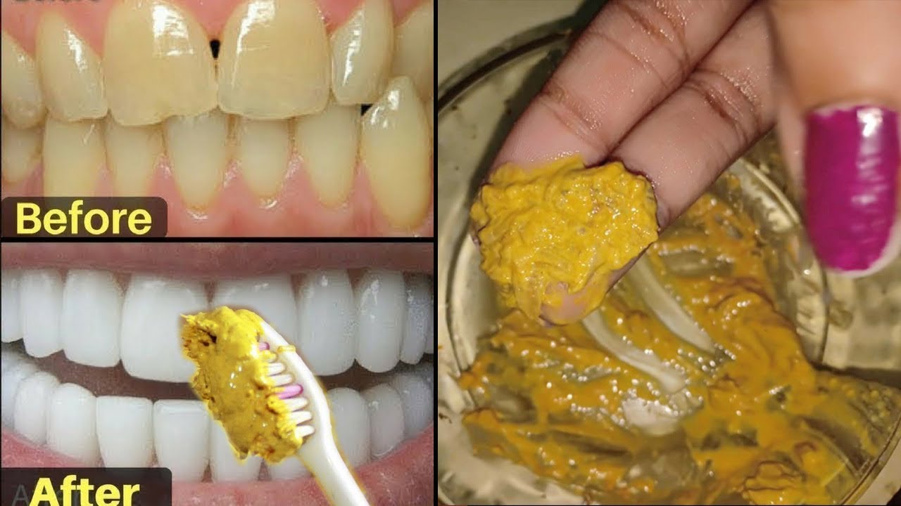 2 मिनट- गंदे पीले दांतो को सफ़ेद और चमकदार बनाने का कारगर नुस्खा | Teeth Whitening at Home - YouTube