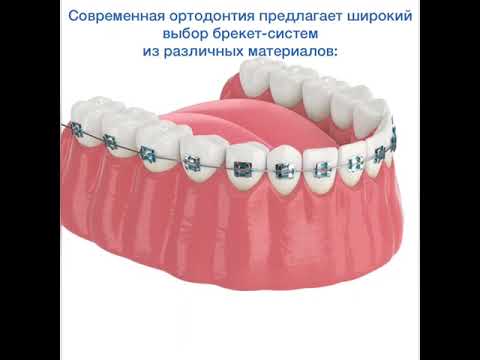 Выравнивание зубного ряда при помощи брикет-системы #брекеты #лечениезубов #стоматология_все_свои