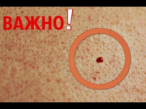 Что Означают Красные Родинки на Коже! Это должен Знать Каждый!