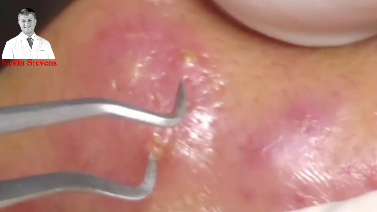 cystic acne extraction