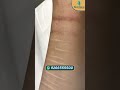 Non surgical scar improvement only at SkinQure Delhi | Laser Scar Removal