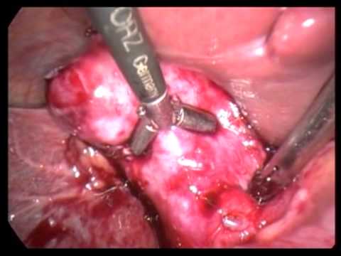 Lap  Cholecystectomy Converted To Open