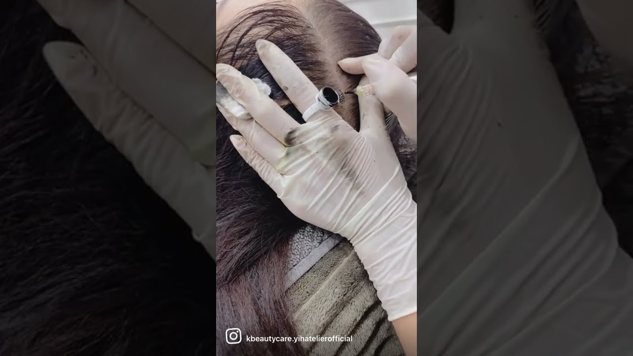 Sula Rambut Sulam Rambut - Rambut Tipis & Botak Teratasi - YouTube