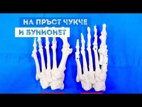 Корекция на пръст чукче и бунионет