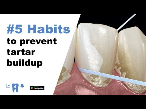 How to prevent buildup of tartar on your teeth.