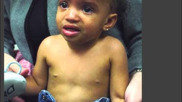 DELETION 4P SYNDROME(WOLF HIRSCHHORN SYNDROME)