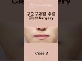 [구순구개열] 2차 수술 다양한 케이스 별 교정