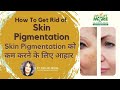 Diet Plan For Hyperpigmentation - Reduce Skin Pigmentation - Nutrition Deficiency - Home Remedies