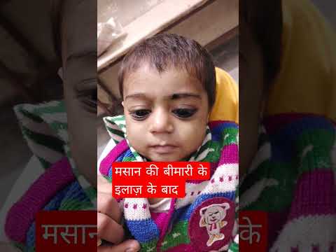 मस न क ईल ज क ल ए जबरदस त इल ज Shorts Medical Cupping