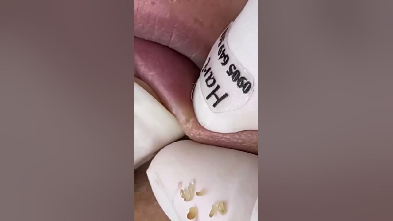 Whitehead extraction Part 2 YouTube