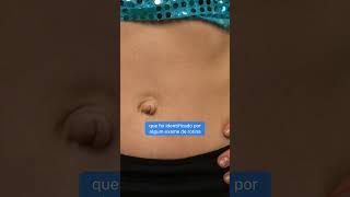 Does an umbilical hernia without symptoms require surgery or medical follow-up?