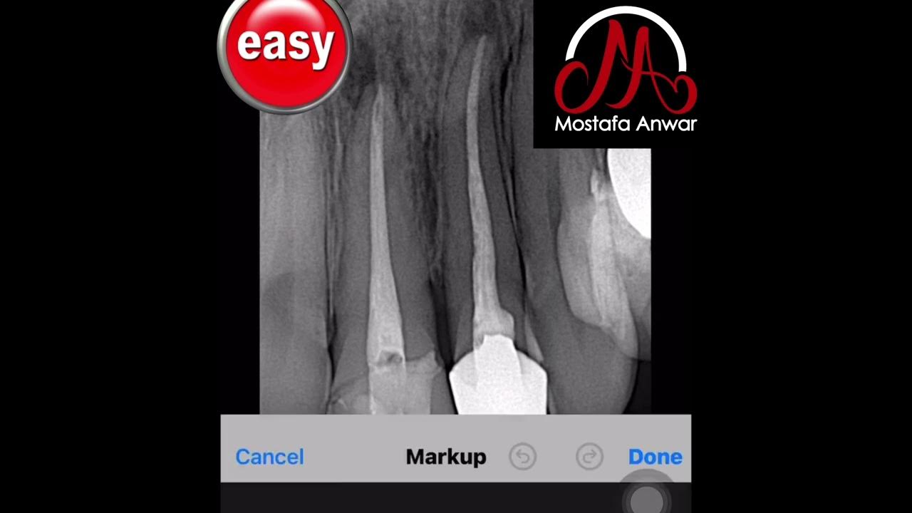 How to Remove Gutta Percha during Retreatment of Upper Central Incisor