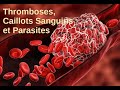 Capsule Exploration Thromboses, Caillots Sanguins et Infections Parasitaires