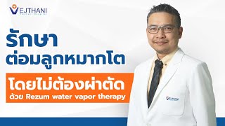 รักษาต่อมลูกหมากโตโดยไม่ต้องผ่าตัด ด้วย Rezum Water Vapor Therapy  l Vejthani's Scoop