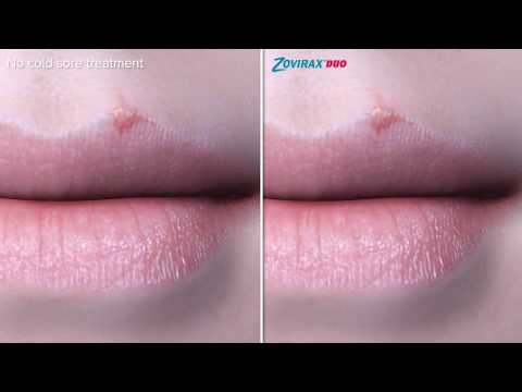 Video: Zovirax Duo-Active - Instructies Voor Het Aanbrengen Van Crème, Prijs, Beoordelingen