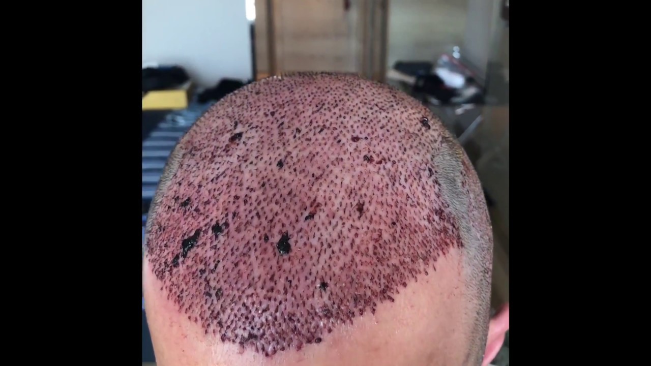FUE hair transplant Turkey 2018 day 2 - YouTube