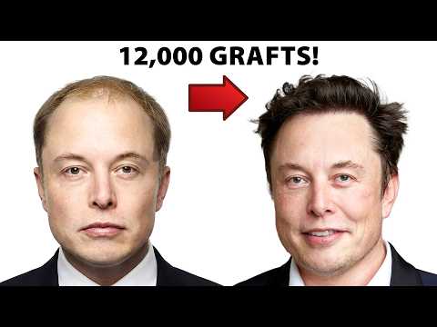 Have Hair Transplant Gigasessions Gone Too Far?