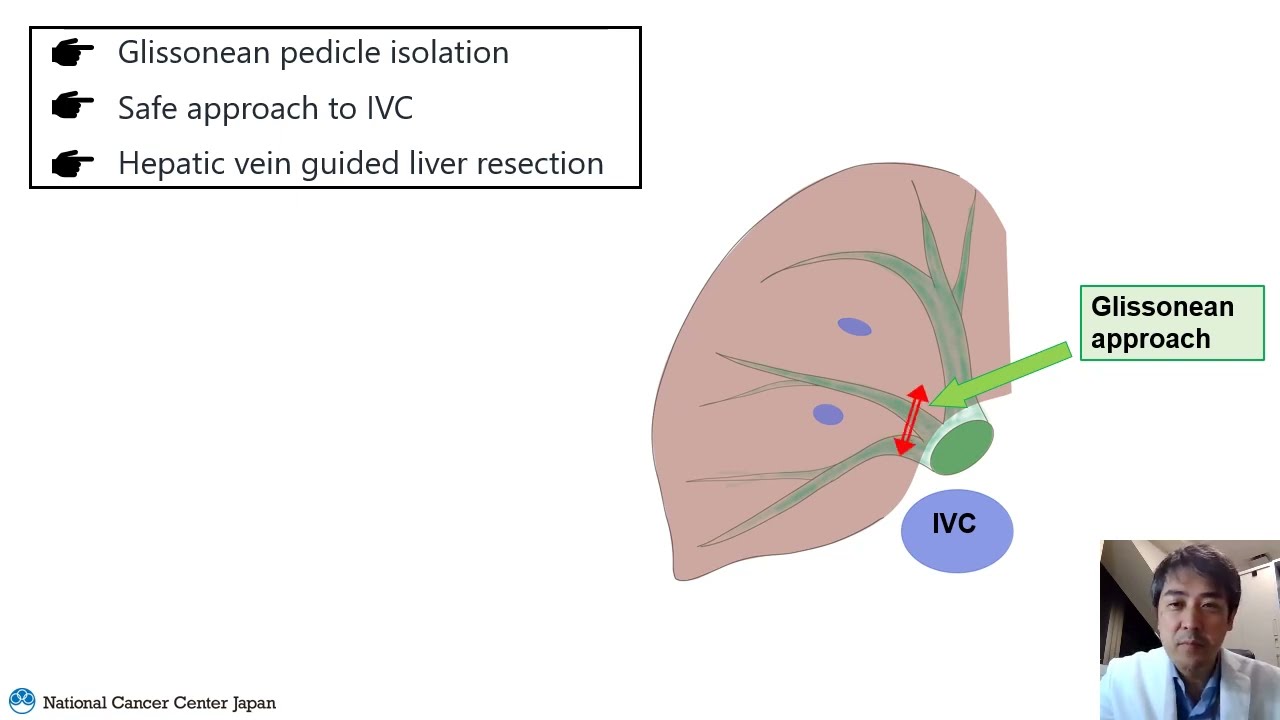 [HR] The talk about laparoscopic liver resection