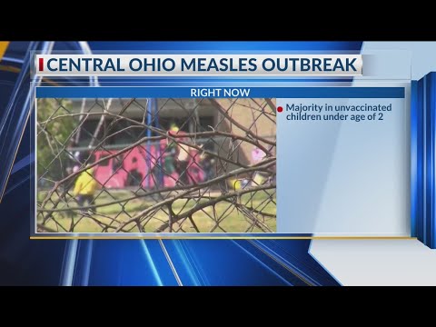 Ohio measles outbreak reaches more than 70 cases