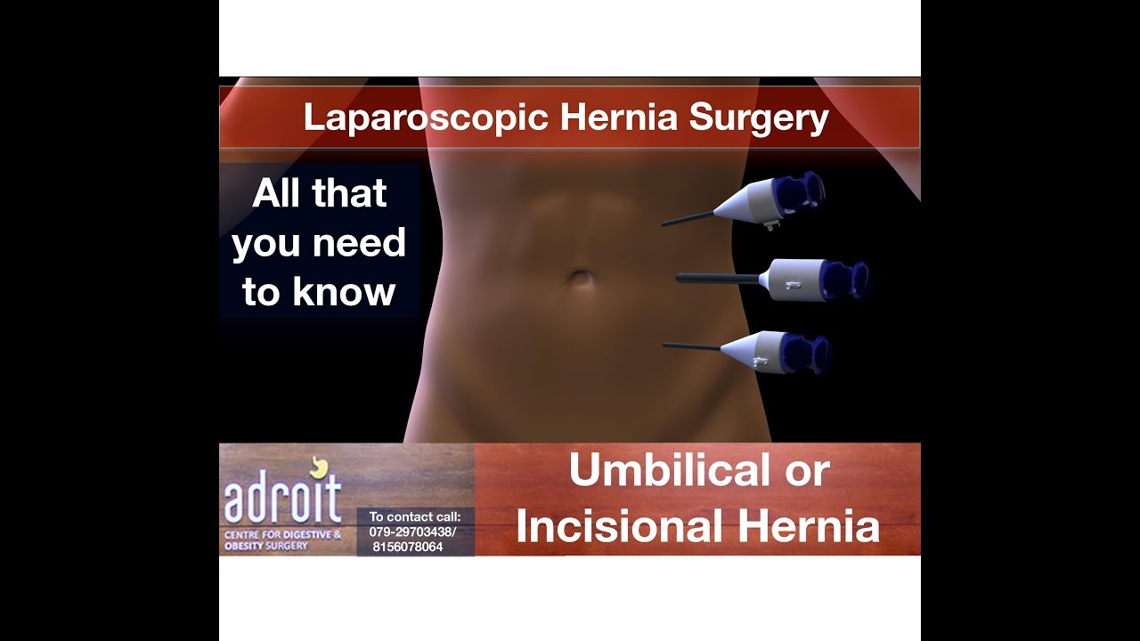 Umbilical Hernia  The Happy Surgeon