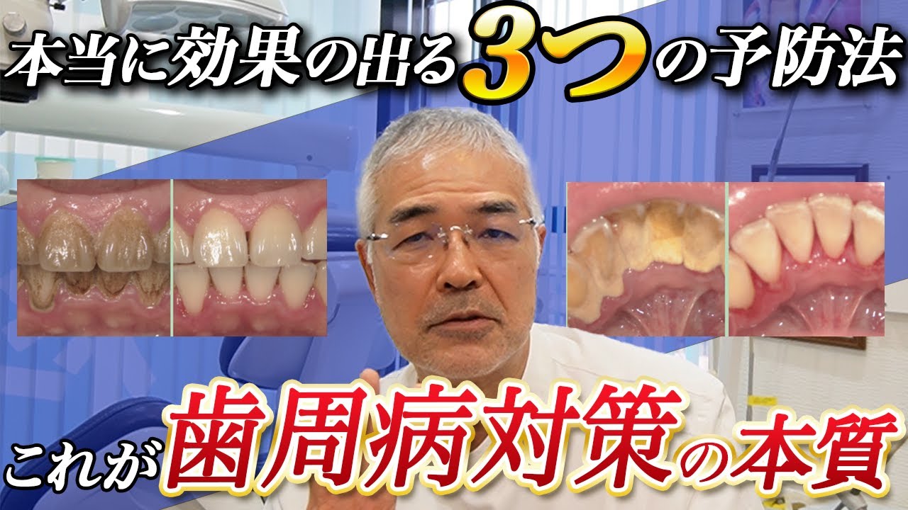 動画]【本当に伝えたい】本当に効果の出る3つの歯周病予防法（医学論文