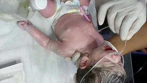 Newborn Baby First Assessment  Receivi from Labor Room with Oxygen Support Suction & NICU Nurse Care