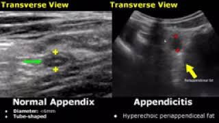 Appendix ultrasound/vs/normal abdominal image appearrecess appendicitis USG scan