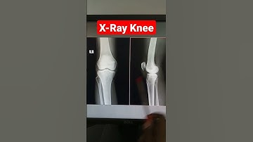 Digital X-Ray Knee Joint #Normal #shots
