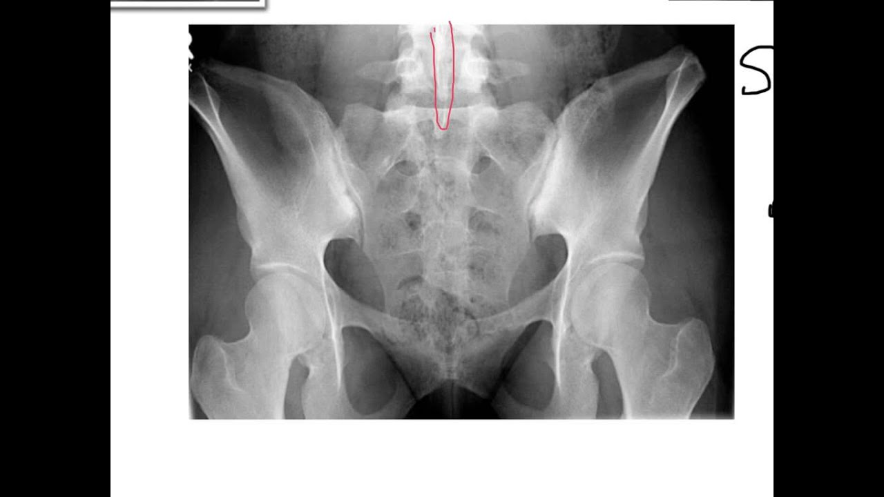 sacrum anatomy xray