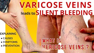 Varicose Veins Explained Dr.dayananda R D I Publicone Media